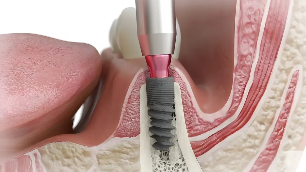 Dental Implants & Bone Grafting